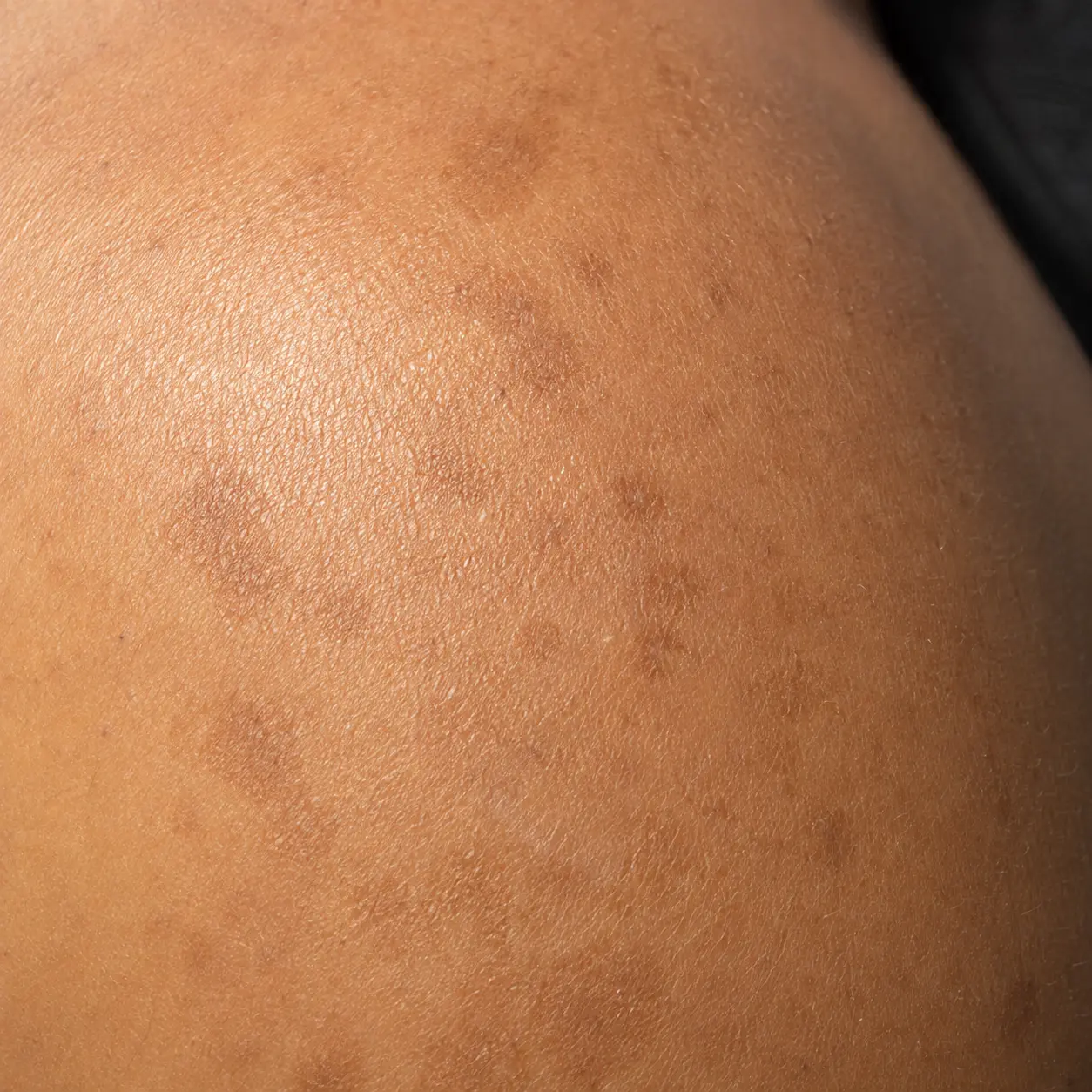 Close-up of patchy sun-induced pigmentation and tanning from prolonged UV exposure