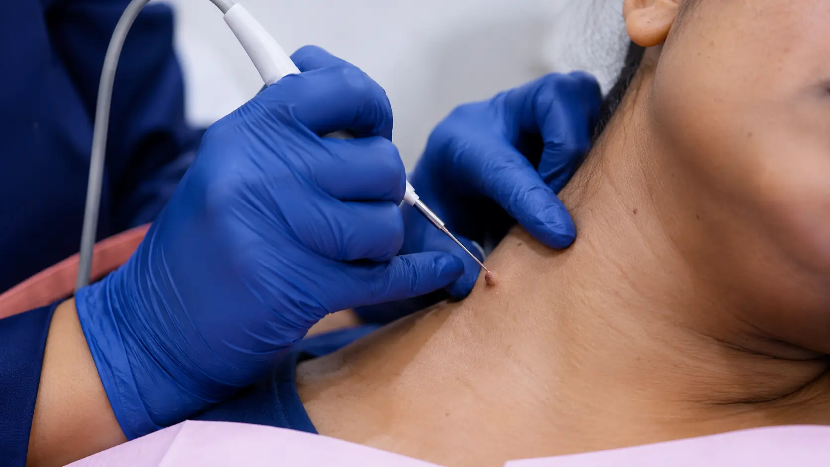 Dermatosurgery — Minor Skin Surgeries at Smart Surgeons